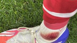 “Where is the VAR? What a shame!”: Braga explodes over Pau Víctor’s bloody foot